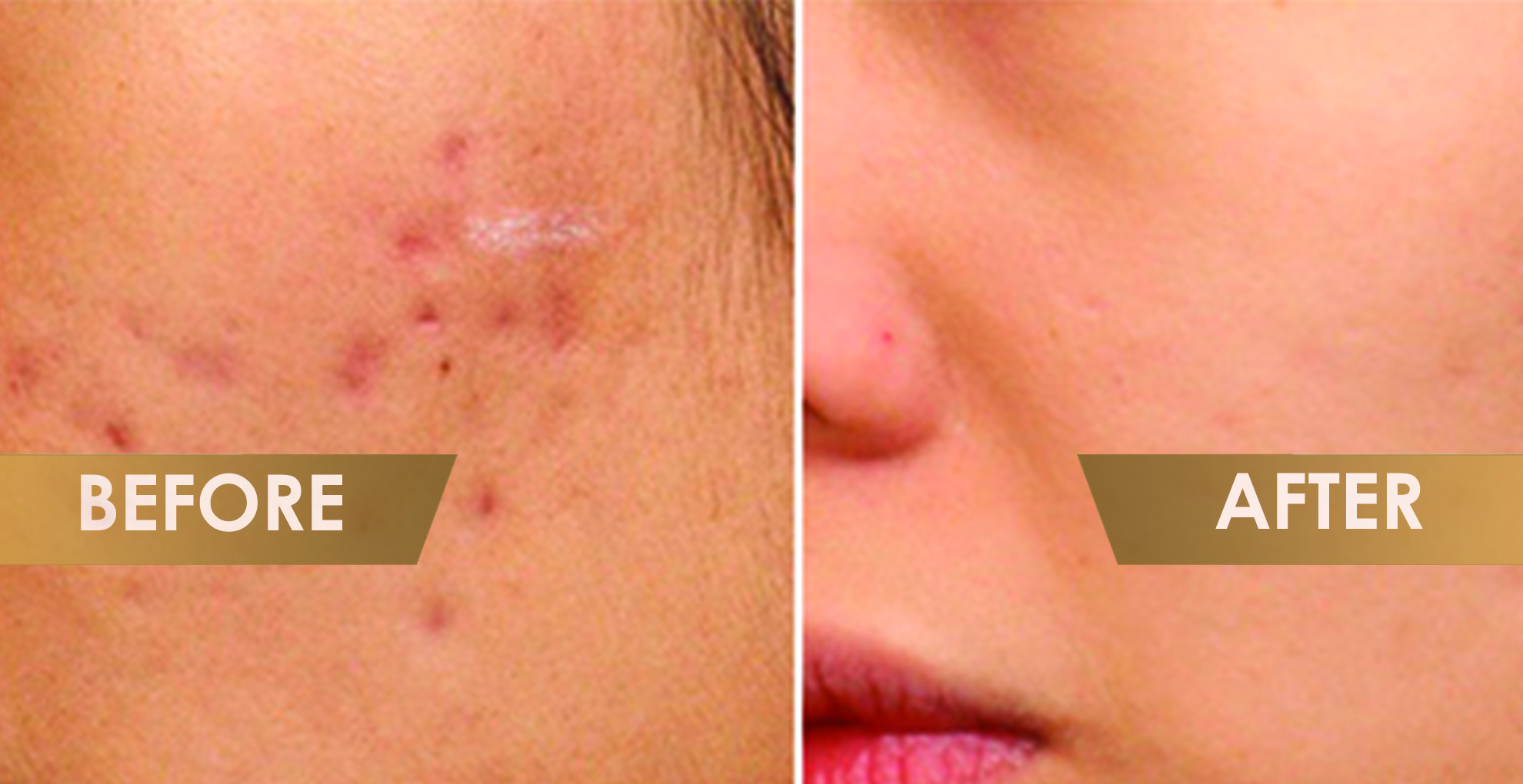 Calayan Skin Clinic - Lucena City - How to get rid of SCARS on