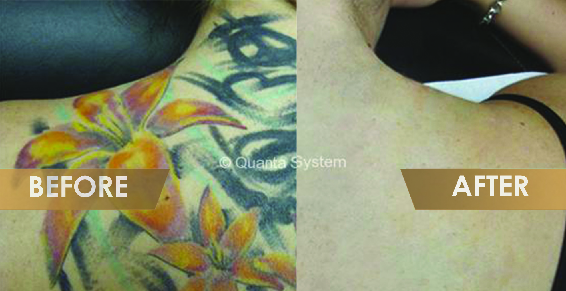 The Latest Technology In Tattoo Removal Is Here